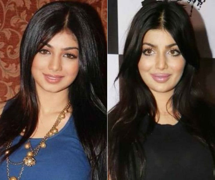 Lip Surgery, Bollywood Actresses went wrong