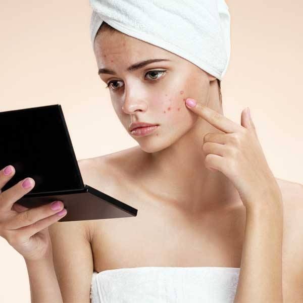 मुहांसों से छुटकारा पाने के 5 आसान घरेलू उपाय (5 Home Remedies To Get Rid Of Pimples Naturally)