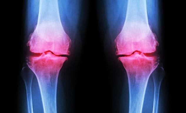 Osteoarthritis Causes