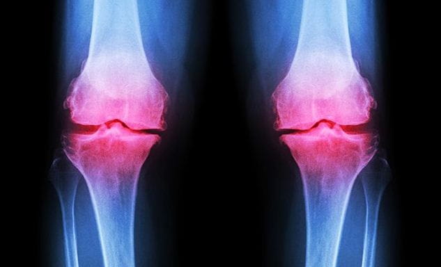 Osteoarthritis Causes