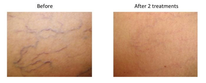 Laser Treatments For Superficial Vascular Lesions