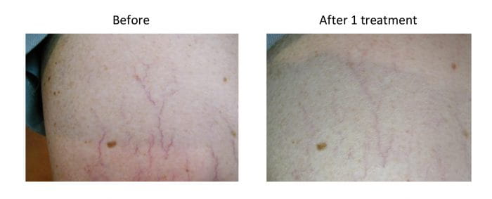 Laser Treatments For Superficial Vascular Lesions