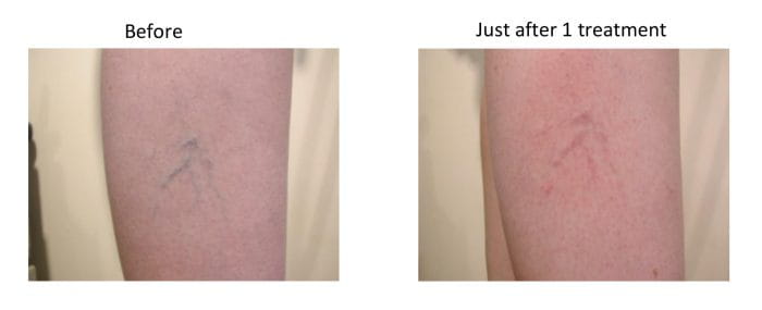 Laser Treatments For Superficial Vascular Lesions